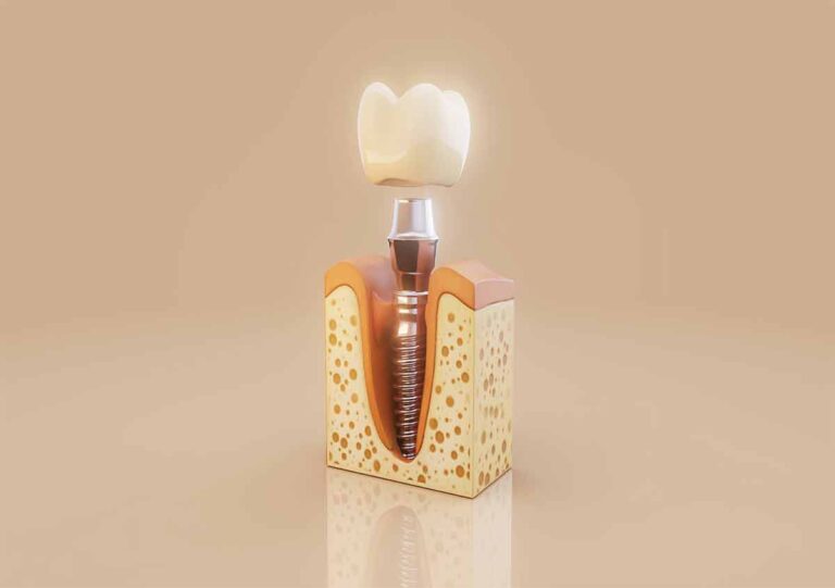 Dental Implants With Bone Loss