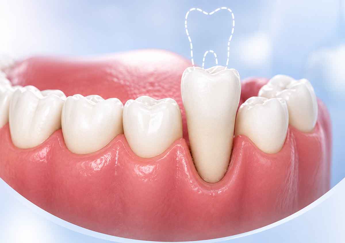 Can a Super-Erupted Tooth Be Saved